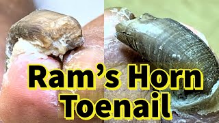 Rams Horn Toenail Severe Fungal Toenail [upl. by Lovel]