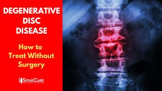 What is DEGENERATIVE DISC DISEASE  How to Treat It WITHOUT SURGERY [upl. by Abe]