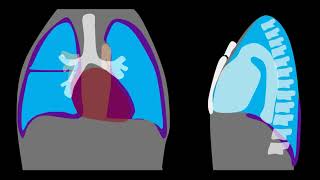 Pneumothorax Explained by Prometheus Lionhart MD [upl. by Sherris579]