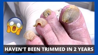 CUTTING AND GRINDING CRAZY TOENAILS  Toe Fungus Journey [upl. by Glialentn]