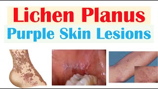 Lichen Planus “Purple Skin Lesions”  Causes Signs amp Symptoms Diagnosis Treatment [upl. by Bell529]