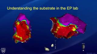 My SVT catheter ablation experience [upl. by Warring836]