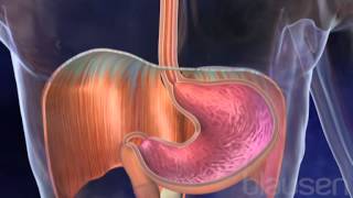 Hiatal Hernia Animation [upl. by Eimerej]