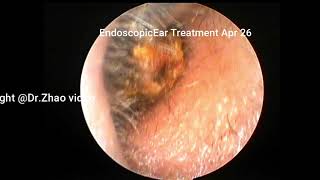 Management of external auditory canal cholesteatoma under general anesthesia 11 minutes [upl. by Mlawsky]