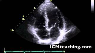 Apical 4 Chamber normal [upl. by Ocinemod]
