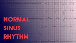 Normal Sinus Rhythm  EKG ECG Interpretation [upl. by Tsnre333]