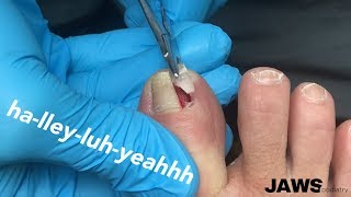 REMOVING A LARGE INGROWN TOENAIL [upl. by Ahtelrac136]