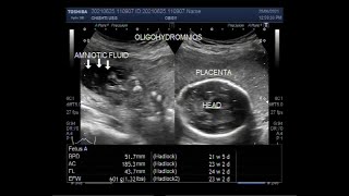 Oligohydramnios with loss of fetal movements and Pregnancy of about 23 weeks [upl. by Sawyer]