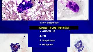 Thyroid Cytology I Approach [upl. by Merill]