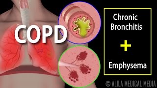 COPD  Chronic Obstructive Pulmonary Disease Animation [upl. by Seem594]