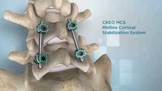 Globus Medical CREO MCS™ [upl. by Koziel640]