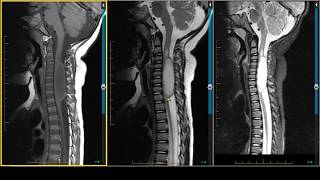 LongTerm Survivors of Glioblastoma [upl. by Gonzalez189]