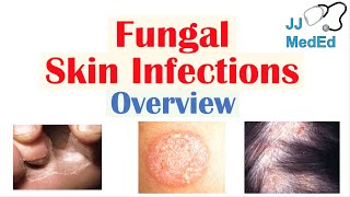 Overview of Fungal Skin Infections  Tinea Infections [upl. by Aleibarg]