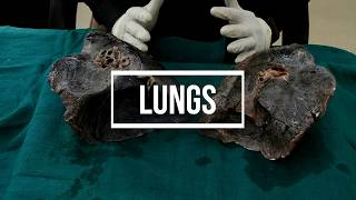 Lungs  gross anatomy [upl. by Wolsniw]