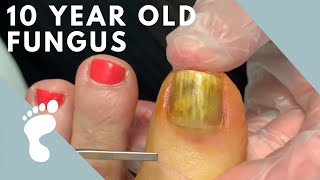 Fungus Takes Over Toenail  Toenail Removal [upl. by Naujad]