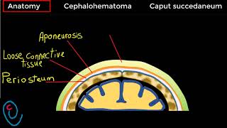 Cephalohematoma versus Caput succedaneum [upl. by Adnilrev]