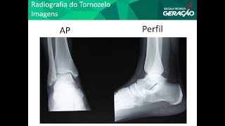 Radiografia do Tornozelo  AP  Perfil [upl. by Almund874]