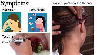 Infectious mononucleosis  Easy explained [upl. by Aramenta924]