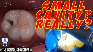 What are Dental Caries Treatments Signs and Symptoms  OralB [upl. by Eerual]