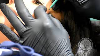 MicroDermal Procedure [upl. by Ame542]