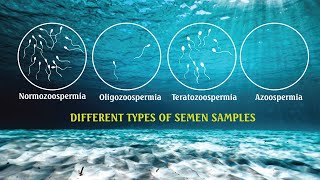 Semen analysis Samples OLIGOZOOSPERMIA ASTHENOZOOSPERMIA  TERATOZOOSPERMIA SPERM COUNT [upl. by Ahsa397]