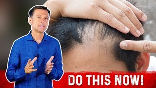 Receding Hairline Causes And Remedies – DrBerg [upl. by Bowler720]