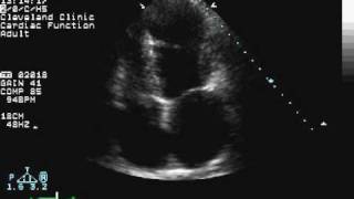 Apical Wall Motion Abnormality [upl. by Airdnalahs]