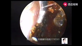 This case of cholesteatoma of the auditory canal was eventually removed under general anesthesia [upl. by Hilary]