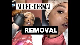 MicroDermal Piercing Removal  Piercing Update [upl. by Kelleher914]