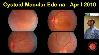 Cystoid Macular Edema [upl. by Geer]