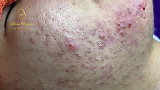 Blackheads Removal 333a  Loan Nguyen [upl. by Refenej]