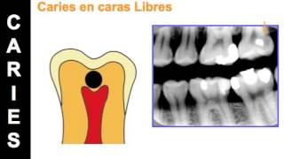 Cariology Part 7 Types of Caries [upl. by Joh324]