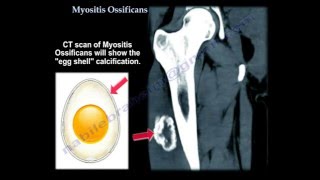 Myositis Ossificans  Everything You Need To Know  Dr Nabil Ebraheim [upl. by Neelat]