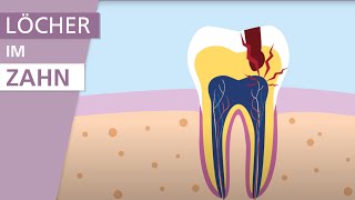 Was ist Karies  Stiftung Gesundheitswissen [upl. by Akiemaj87]