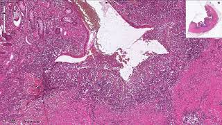 Crohns Disease  Histopathology [upl. by Aidaas291]