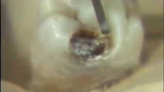 Removal of Carious Lesion [upl. by Lesslie59]